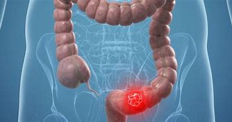 Immagine che raffigura Giornata Mondiale Malattie croniche intestinali